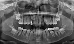 Impacted Canine Surgery in Park Ave | Park Smiles NYC