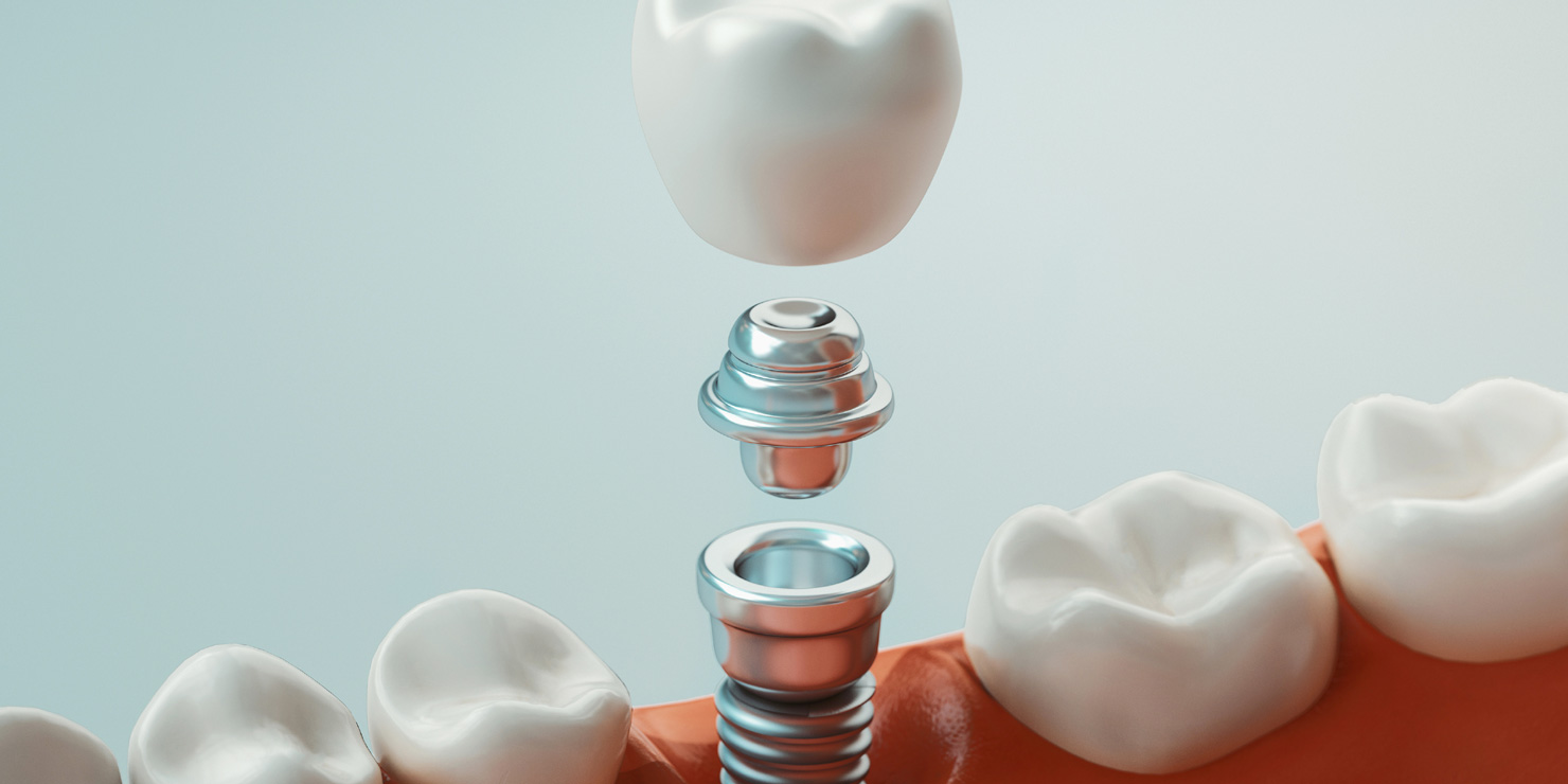 dental implant