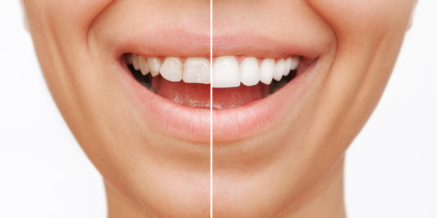 smiling woman before and after veneers are installed