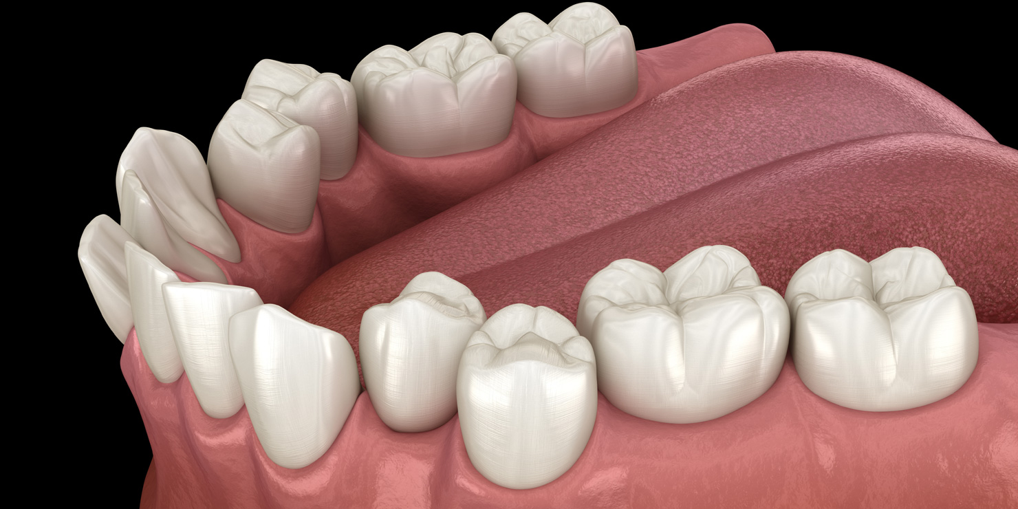 Overcrowded teeth