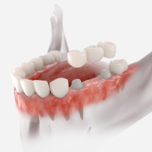 dental bridges