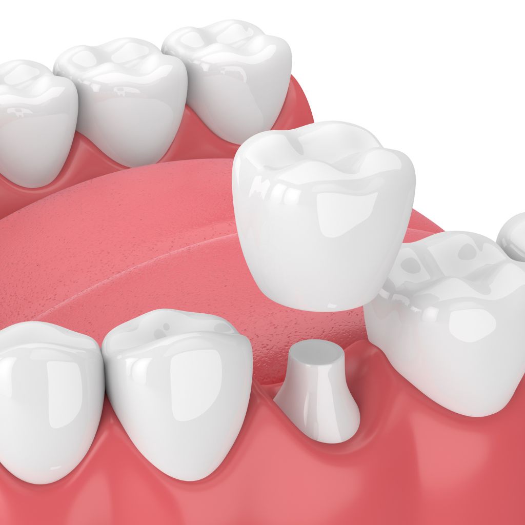 dental crowns